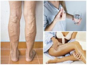 Varices dans les jambes et les méthodes de traitement
