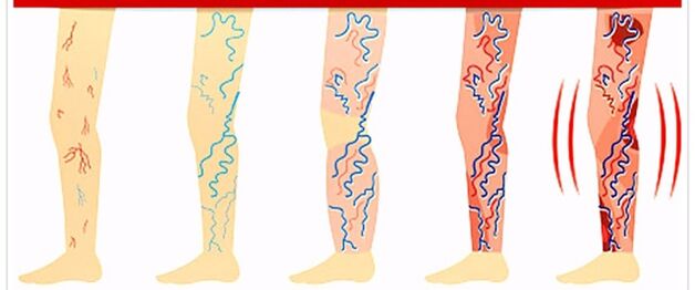 que ne pas faire avec les varices