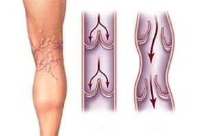 Écoulement de sang dans les varices à différents stades du développement de la maladie.