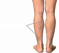 varices sur les jambes